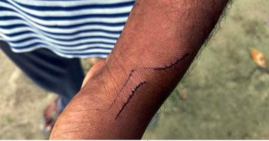 মতলবে পাগলা কুকুরের কামড়ে ২০ নারী-শিশু আহত