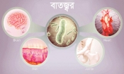 রিউম্যাটিক ফিভার বা বাতজ্বর
