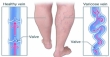ভেরিকোজ ভেইনস: কারণ, লক্ষণ